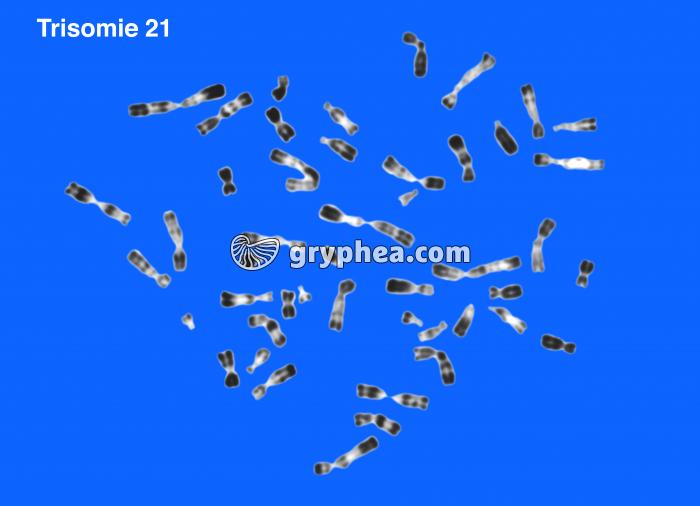 Trisomie 21 non classée - gryphea.com